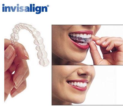 invisalign